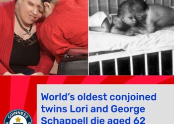 SANTE-Révélation tragique : Les causes du décès des jumeaux siamois les plus âgés du monde enfin dévoilées
