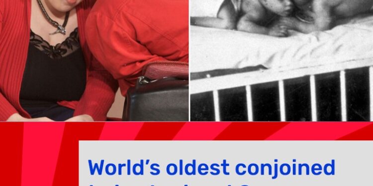 SANTE-Révélation tragique : Les causes du décès des jumeaux siamois les plus âgés du monde enfin dévoilées
