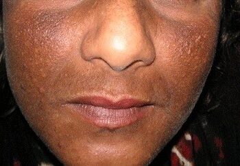 SANTE- Dépigmentation : un fléau silencieux aux lourdes conséquences