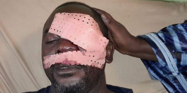 ACTUALITES- Quand la colère aveugle : un journaliste perd un œil sur l’axe